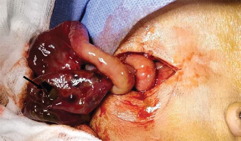 Jejunal perforation.